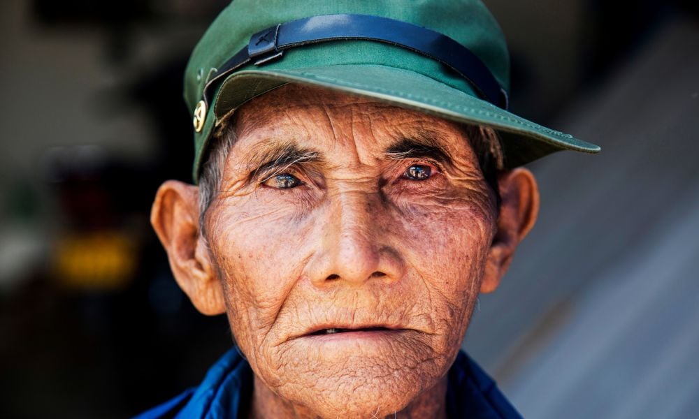 Man from China with cataracts