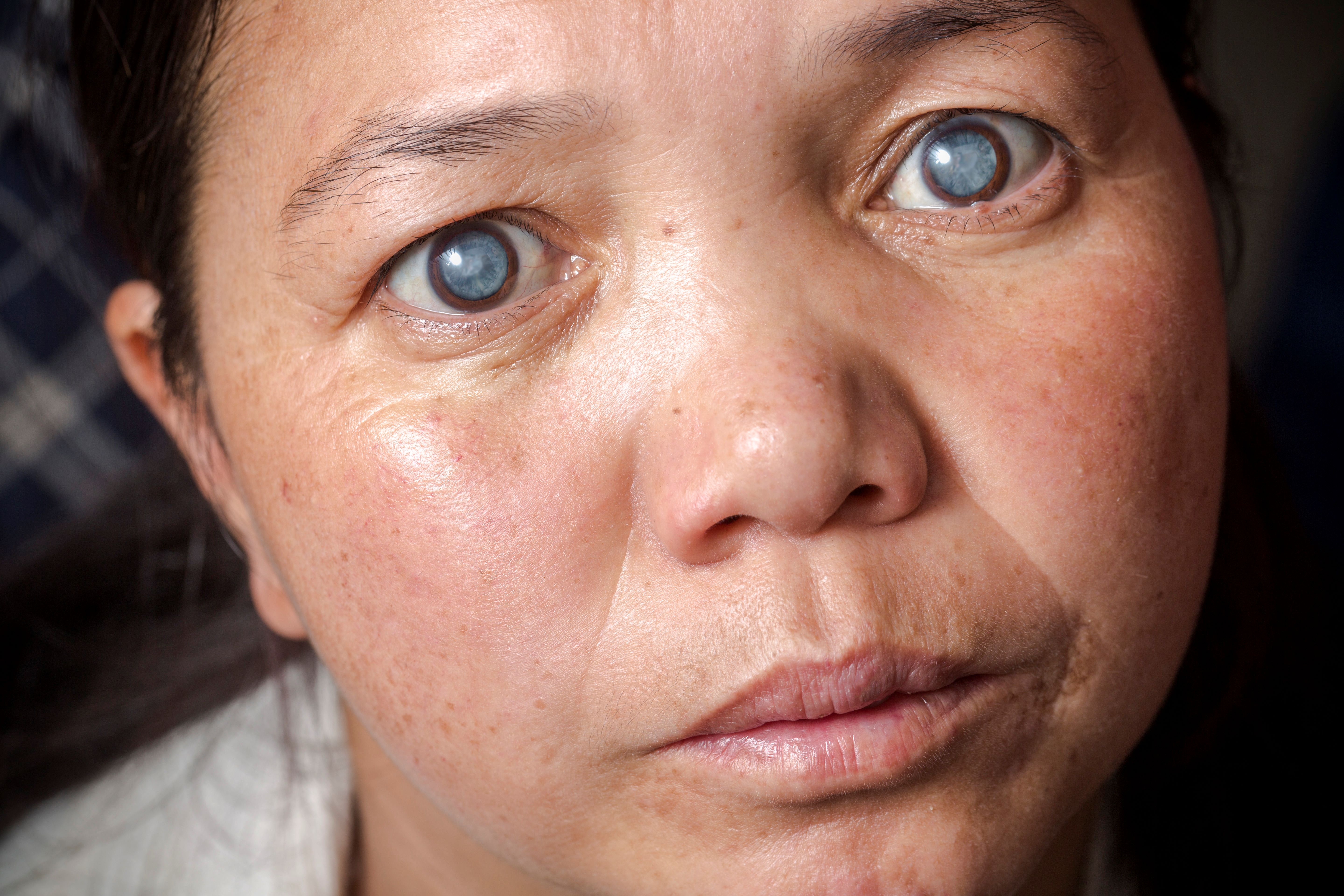 Image of 30-year-old Thinles Lamo. She was photographed by Michael Amendolia just before surgery to restore her sight.