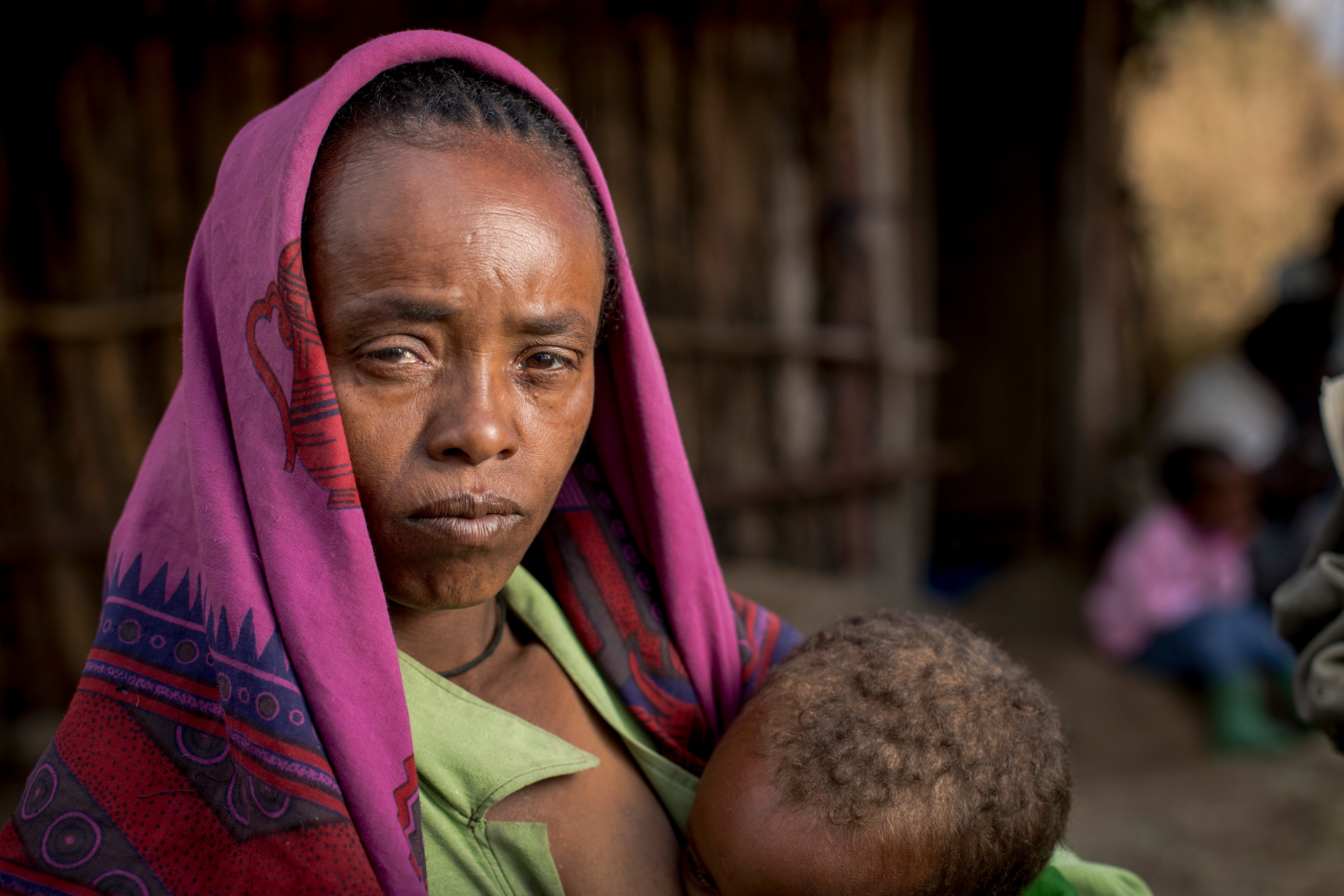 Shashetu looking at the camera with swollen, painful eyes